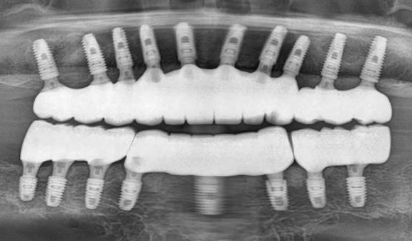 X-RAY 치료 후