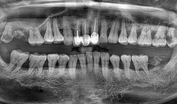 X-RAY 치료 전