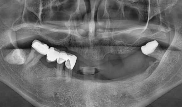 X-RAY 치료 전