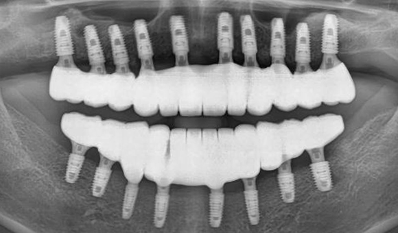 X-RAY 치료 후