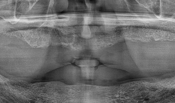 X-RAY 치료 전