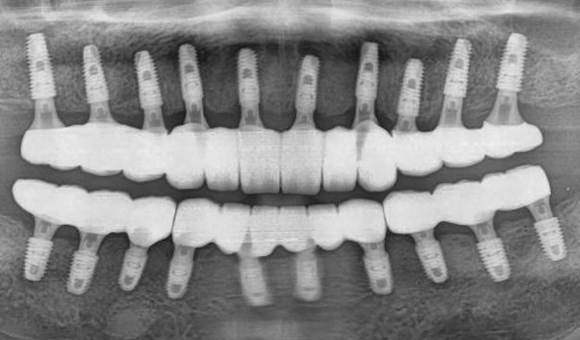 X-RAY 치료 후