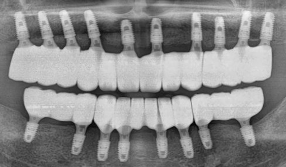 X-RAY 치료 후