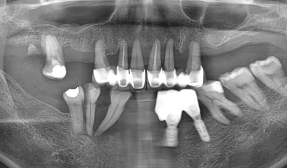 X-RAY 치료 전