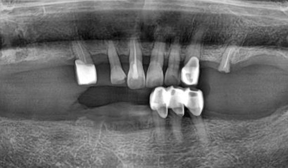 X-RAY 치료 전