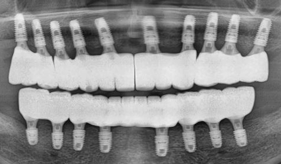 X-RAY 치료 후