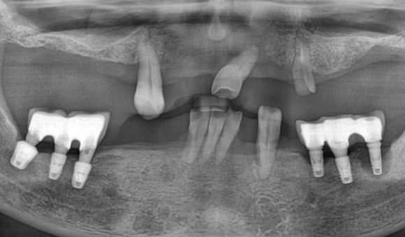 X-RAY 치료 전