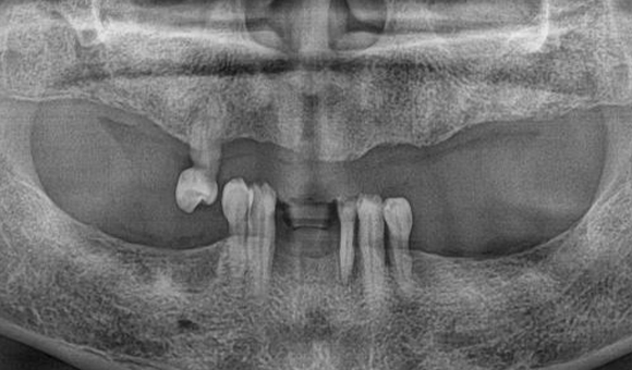 X-RAY 치료 전