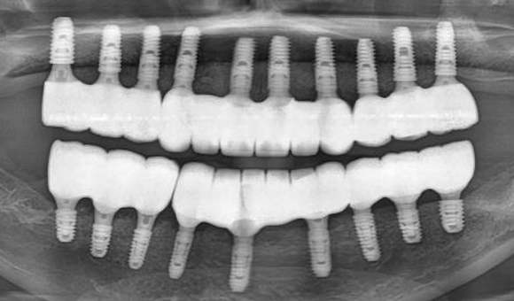 X-RAY 치료 후