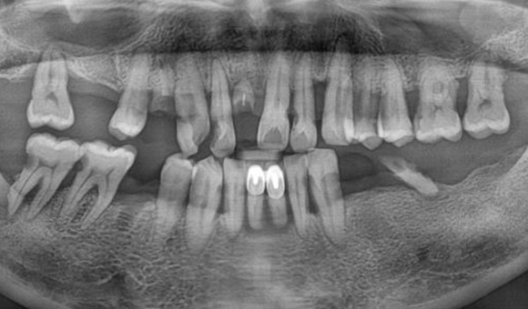 X-RAY 치료 전