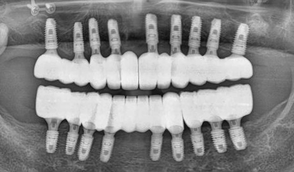 X-RAY 치료 후