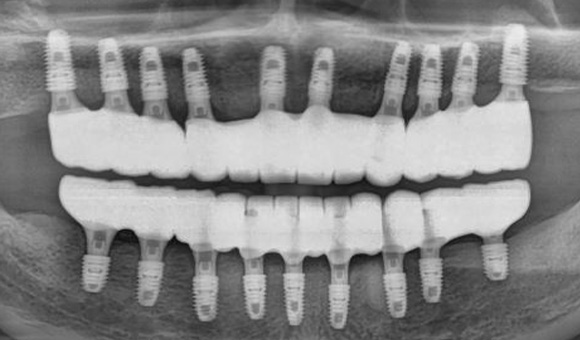 X-RAY 치료 후