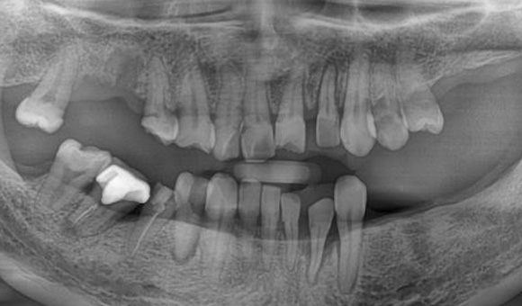 X-RAY 치료 전