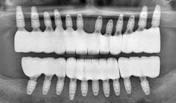 X-RAY 치료 후