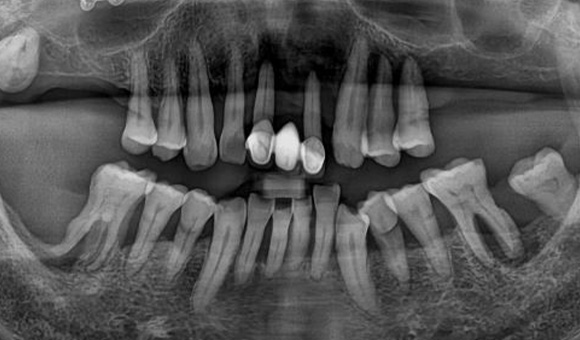 X-RAY 치료 전