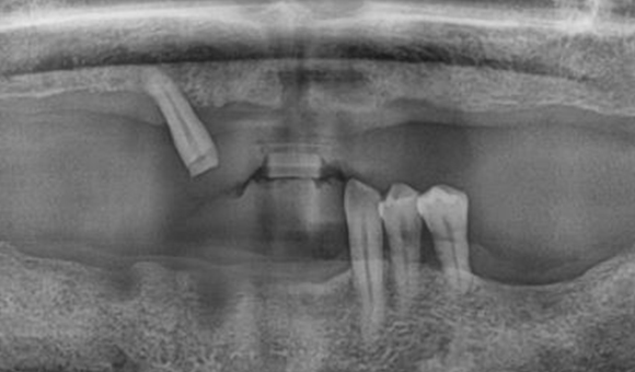 X-RAY 치료 전