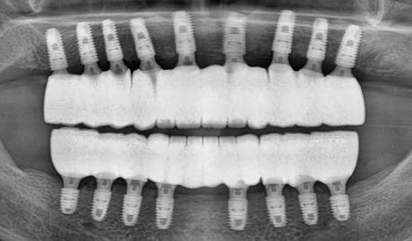 X-RAY 치료 후