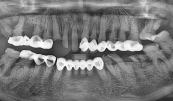 X-RAY 치료 전