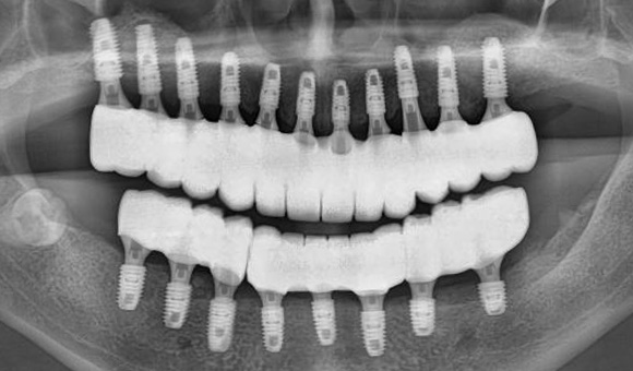 X-RAY 치료 후