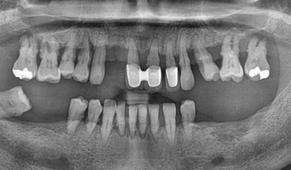 X-RAY 치료 전