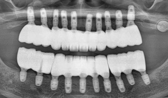 X-RAY 치료 후