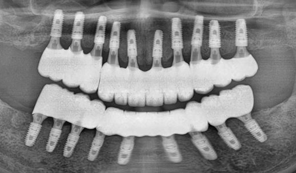 X-RAY 치료 후