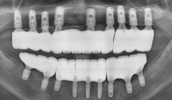 X-RAY 치료 후