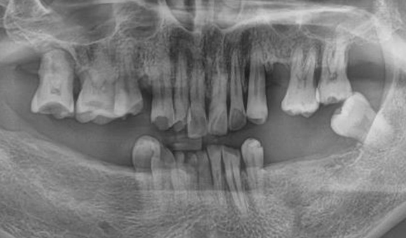X-RAY 치료 전