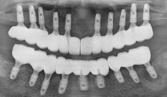 X-RAY 치료 후