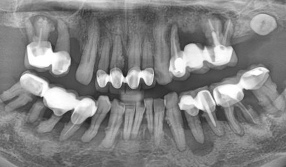 X-RAY 치료 전