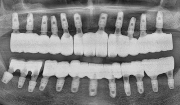 X-RAY 치료 후