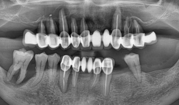 X-RAY 치료 전