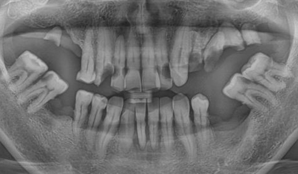 X-RAY 치료 전