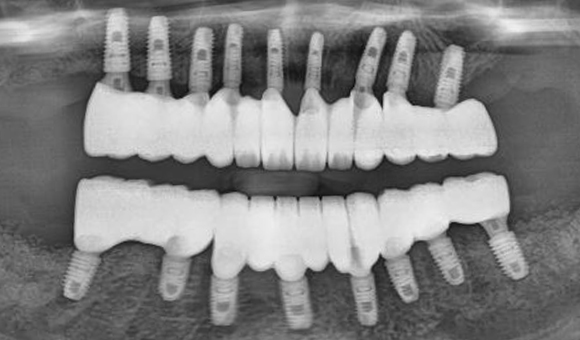 X-RAY 치료 후