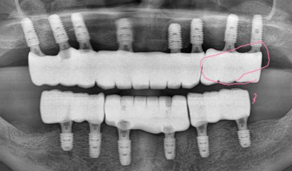 X-RAY 치료 후