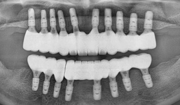 X-RAY 치료 후