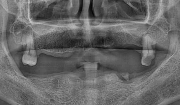 X-RAY 치료 전