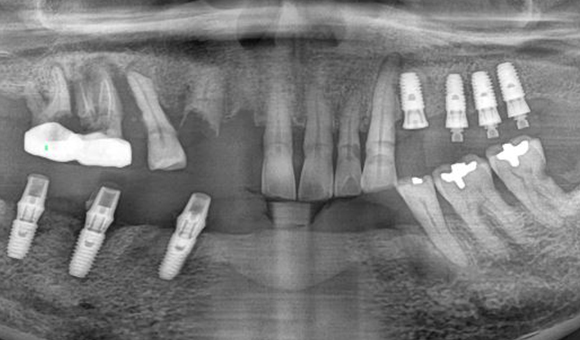 X-RAY 치료 전