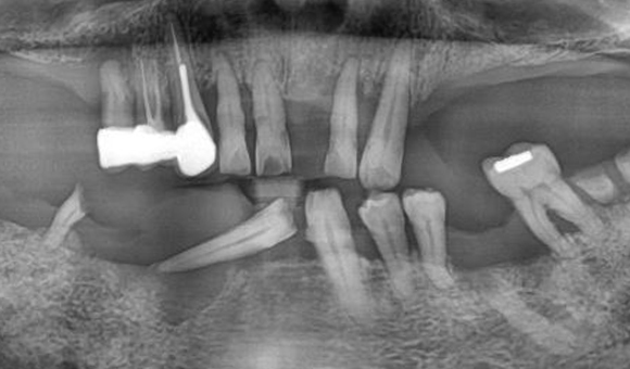 X-RAY 치료 전