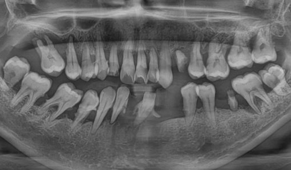 X-RAY 치료 전