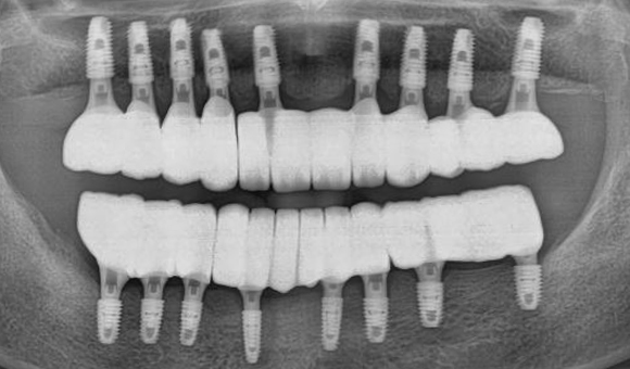 X-RAY 치료 후