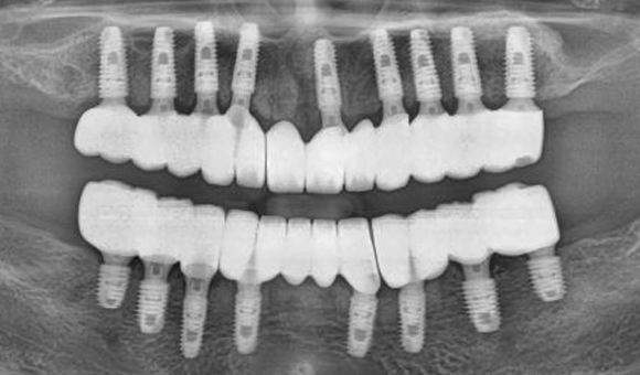 X-RAY 치료 후