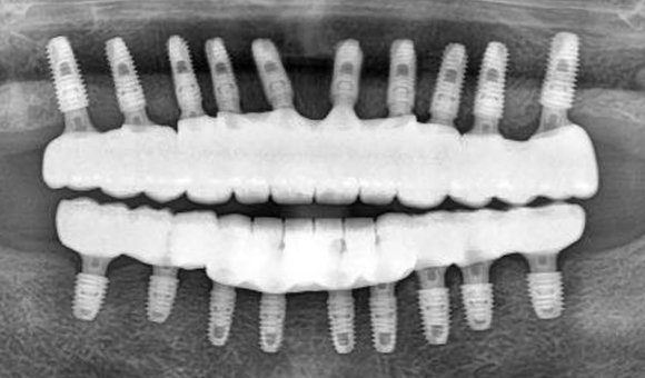 X-RAY 치료 후