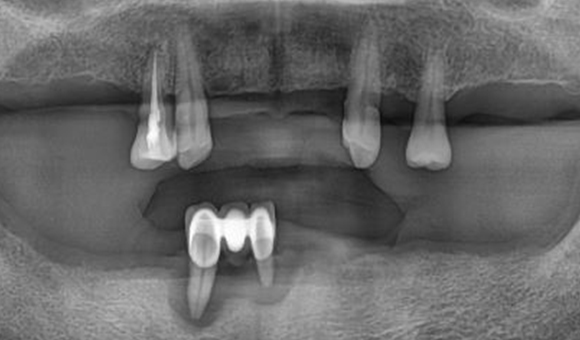 X-RAY 치료 전