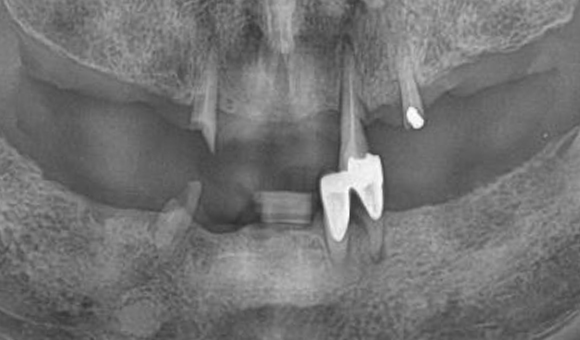X-RAY 치료 전