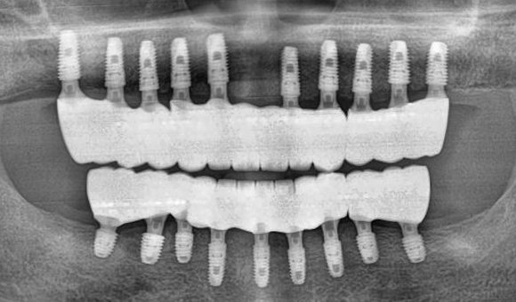 X-RAY 치료 후
