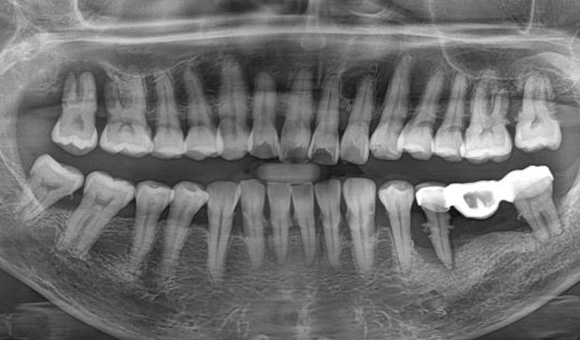 X-RAY 치료 전
