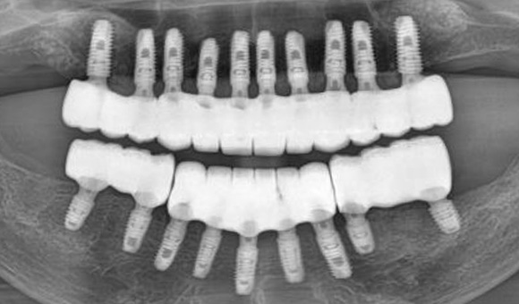 X-RAY 치료 후