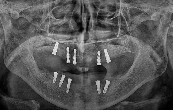 하이브리드 임플란트 x-ray