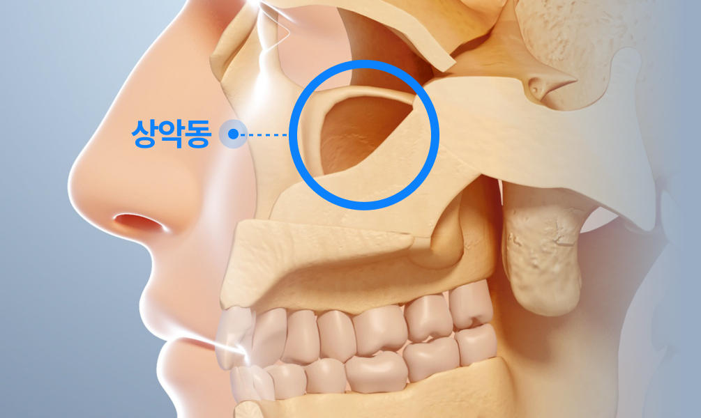 상악동